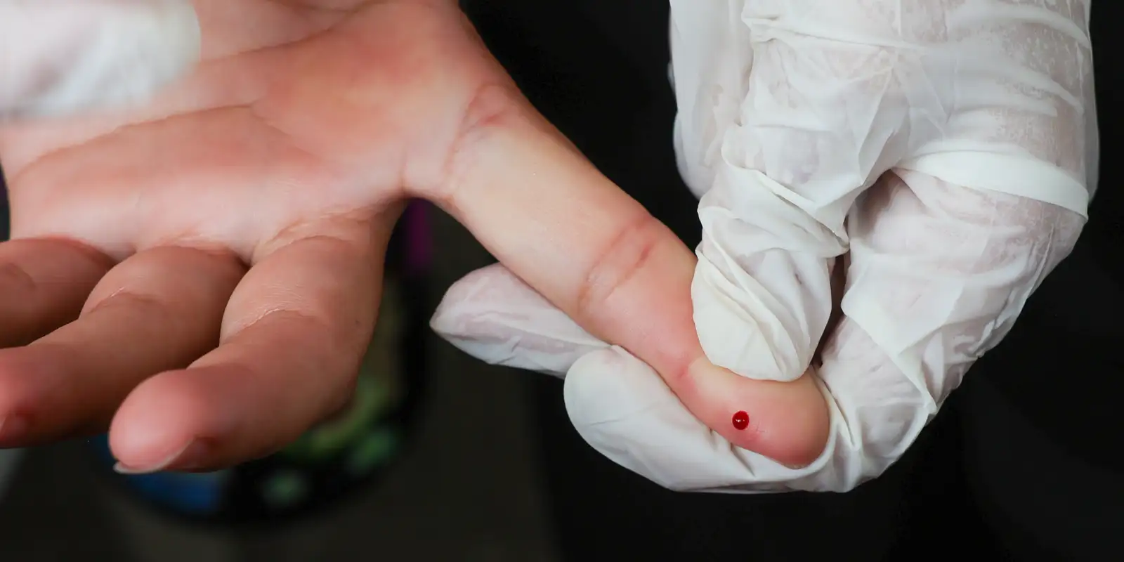 Teste rápido de dengue passa a integrar tabela do SUS